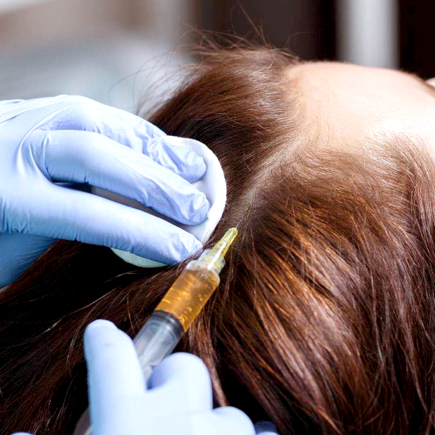 Hair Loss Treatment | Pearl Medical Aesthetics and Laser Center