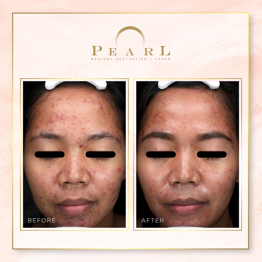 Before and After | Pearl Medical Aesthetics & Laser Center